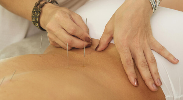 Acupuncture