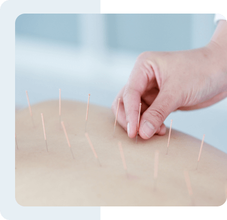 acupuncture-needles